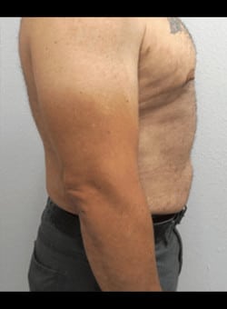Liposuction-Dr. Ovalle