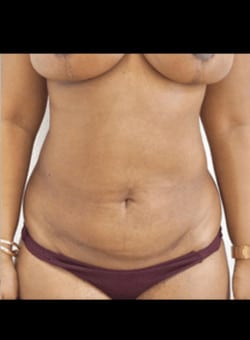 Liposuction-Dr. Fernando Ovalle