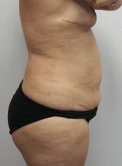 Liposuction-Dr. Fernando Ovalle