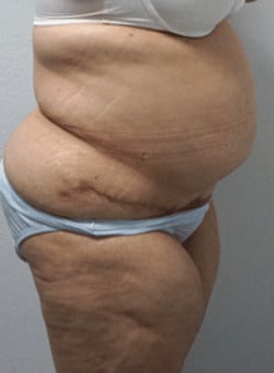 Post Bariatric Abdominal Contouring – Panniculectomy-Dr. Fernando Ovalle