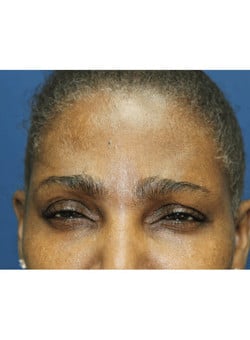 Botox-Dr. Kenrick Spence