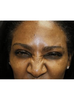 Botox-Dr. Kenrick Spence