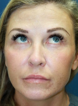 Botox-Dr. Kenrick Spence
