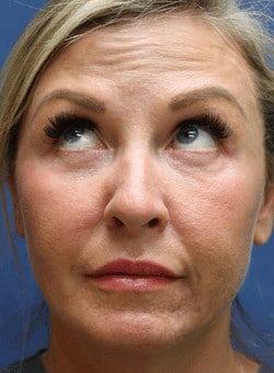 Botox-Dr. Kenrick Spence