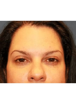 Botox-Dr. Kenrick Spence