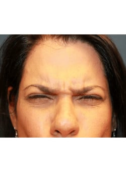 Botox-Dr. Kenrick Spence