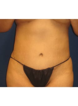 Abdominoplasty-Dr. Fernando Ovalle