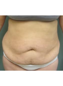 Abdominoplasty-Dr. Fernando Ovalle