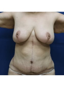 Abdominoplasty, Liposuction, Mastopexy, Fat Grafting-Dr. Fernando Ovalle