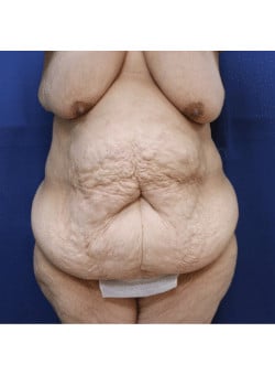 Abdominoplasty, Liposuction, Mastopexy, Fat Grafting-Dr. Fernando Ovalle