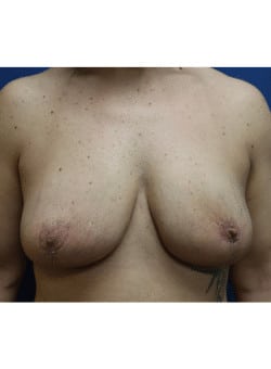 Implant Removal, Capsulectomy, Mastopexy, Fat Grafting, Liposuction – AP Breast-Dr. Fernando Ovalle